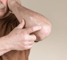 Atoopiline dermatiit - mis see on ja kuidas oma naha eest hoolt kanda?