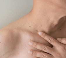 Konnasilmad ja soolatüükad: põhjused, sümptomid ja ravivõimalused