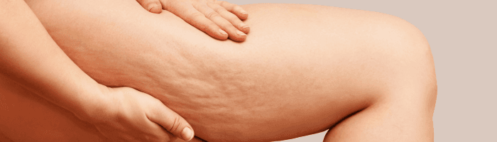 Kuidas ravida ja ennetada venitusarme ja tselluliiti