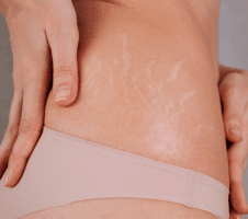 Kuidas ravida ja ennetada venitusarme ja tselluliiti
