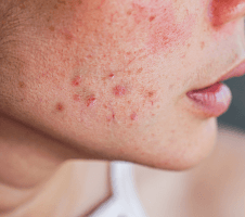 Akne - põhjused, ennetus ja ravi