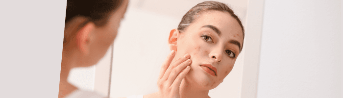 Akne - põhjused, ennetus ja ravi
