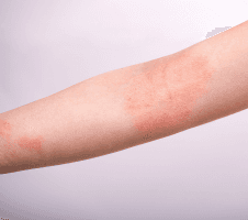 Atoopilise dermatiidi mõistmine ja käsitlemine