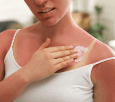 Päikesepõletuse esmaabi ja hooldus