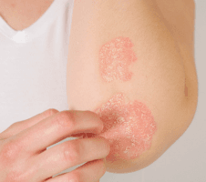 Psoriaas: sümptomid, põhjused ja ravivõimalused
