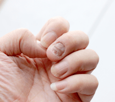 Küüneseen: põhjused, sümptomid ja tõhusad ravivõimalused