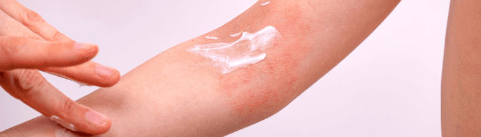 Atoopilise dermatiidi mõistmine ja käsitlemine