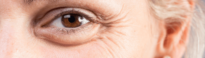 Kuidas vabaneda kottis silmaalustest?