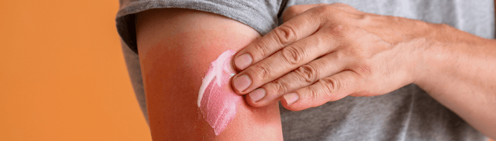 Päikesepõletuse esmaabi ja hooldus